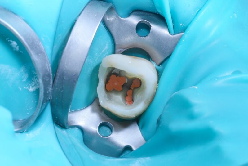 Root Canal Therapy Castle Rock