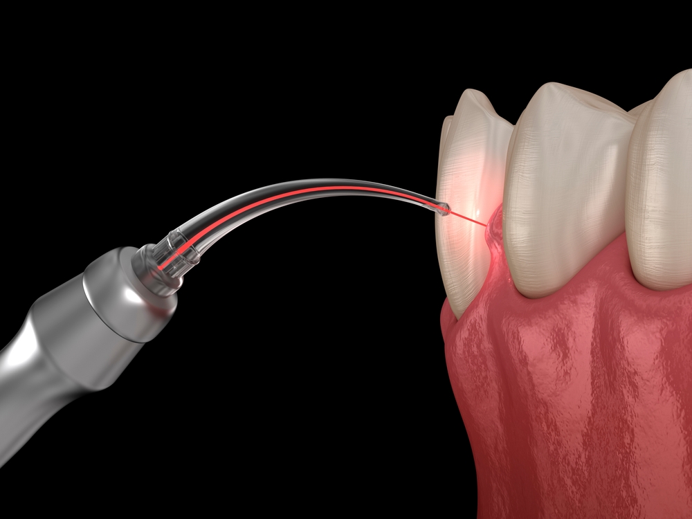 Laser Dentistry in Castle Rock