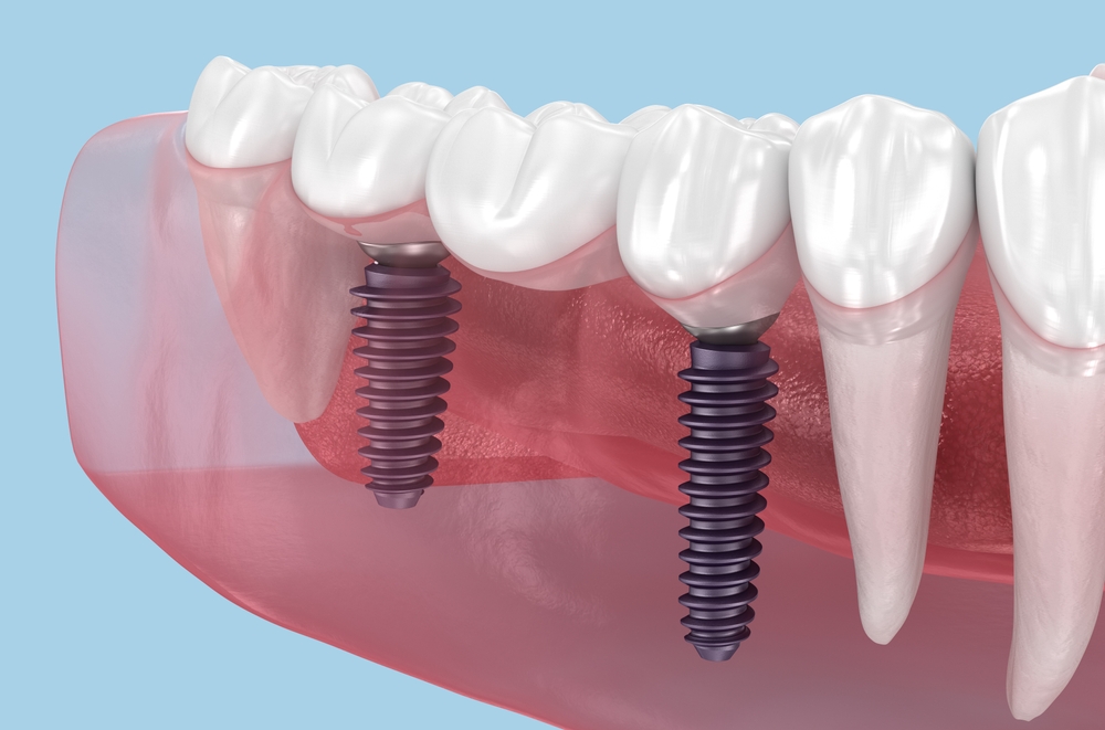 Implant Restorations in Castle Rock